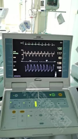 技术突破厉害了句容首例主动脉球囊反搏术iabp成功实施